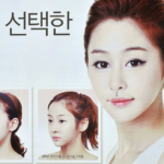 Comparativa de sonrisa natural vs smile lift quirúrgico efecto Joker