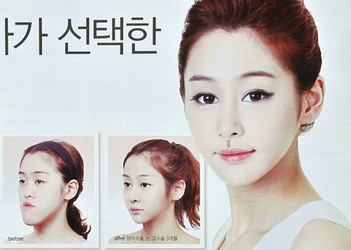 Comparativa de sonrisa natural vs smile lift quirúrgico efecto Joker